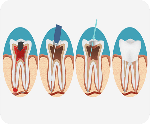 Image of four teeth and root canal therapy on the teeth