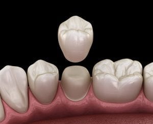 Badly damaged teeth covering with false teeth and other teeth besides
