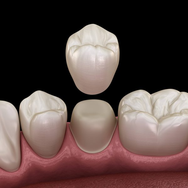 Badly damaged teeth covering with false teeth and other teeth besides