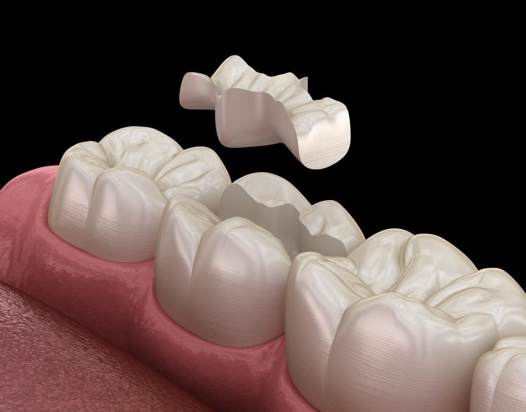 Inlay ceramic crown fixation over tooth. Medically accurate 3D