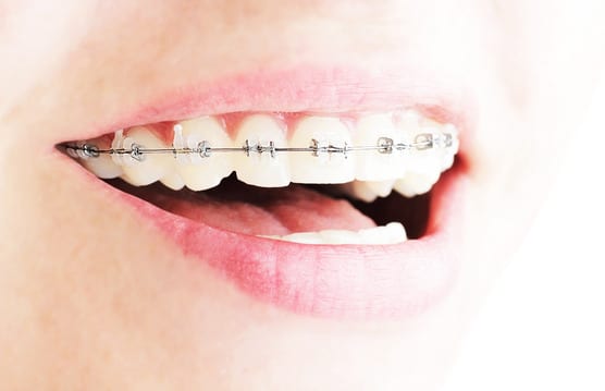 Close up view of woman's teeth braces