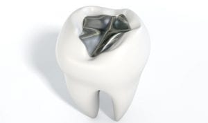 Artificial teeth with filling