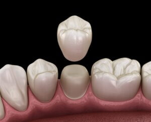 Photo of Dental Crowns and Bridges
