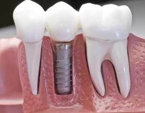 Image of Teeth Model With Screw Indicate Dental Implant