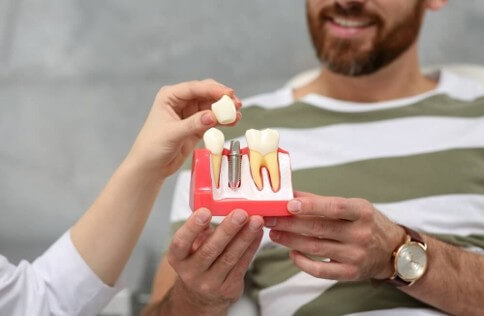 Dental Implants in Macquarie Park