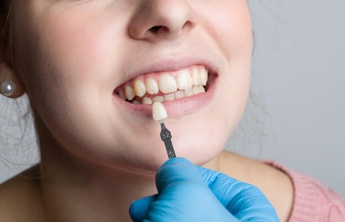 Porcelain vs Composite Veneers Found in Macquarie Park